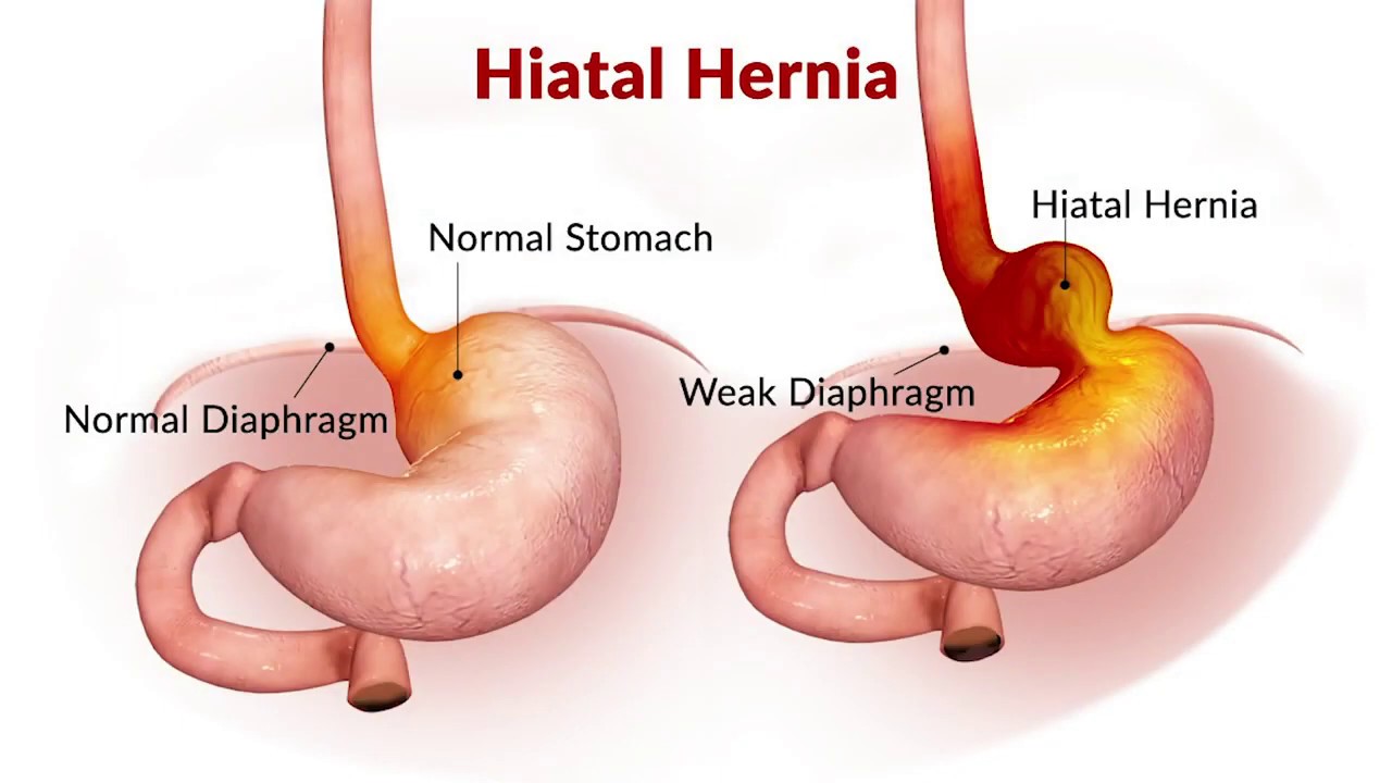 Anti-Reflux Surgery
