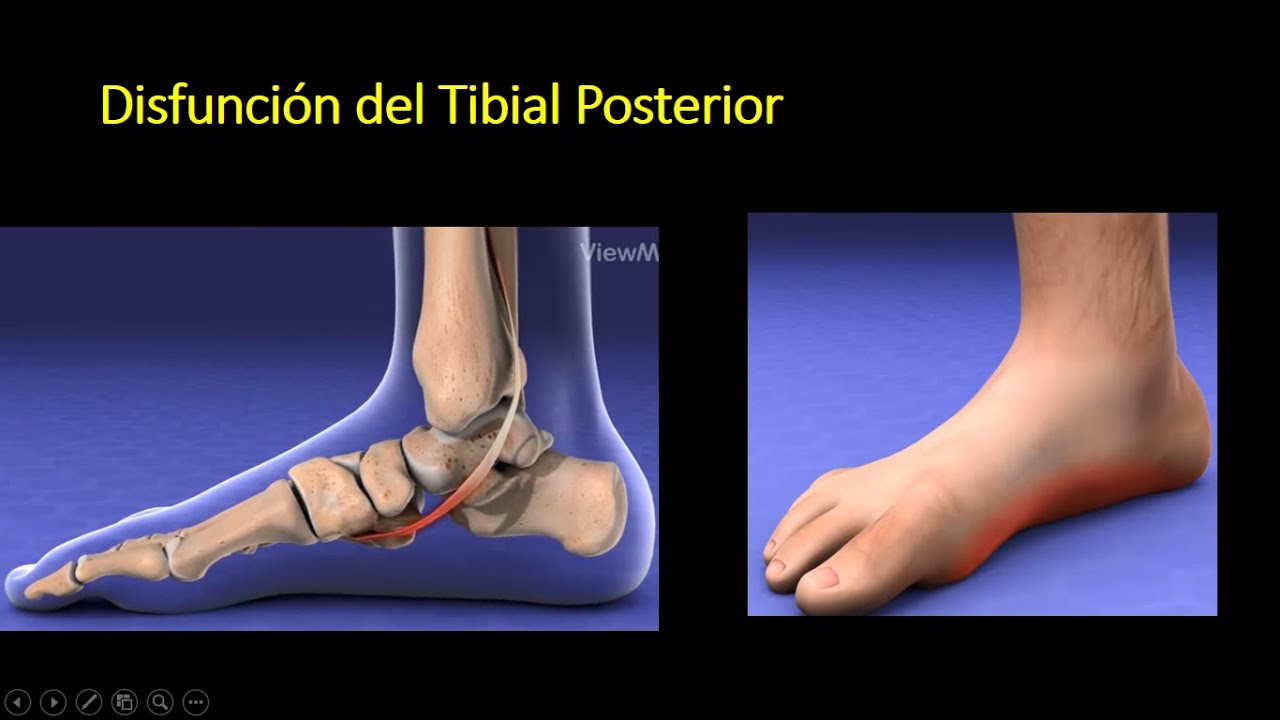 DISFUNCIÓN DEL TENDÓN TIBIAL POSTERIOR