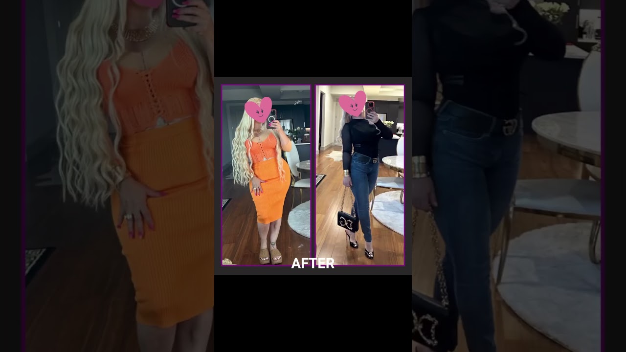 Resultado Postoperatorio De Abdominoplastia Con Curvas | Dr.Cortes