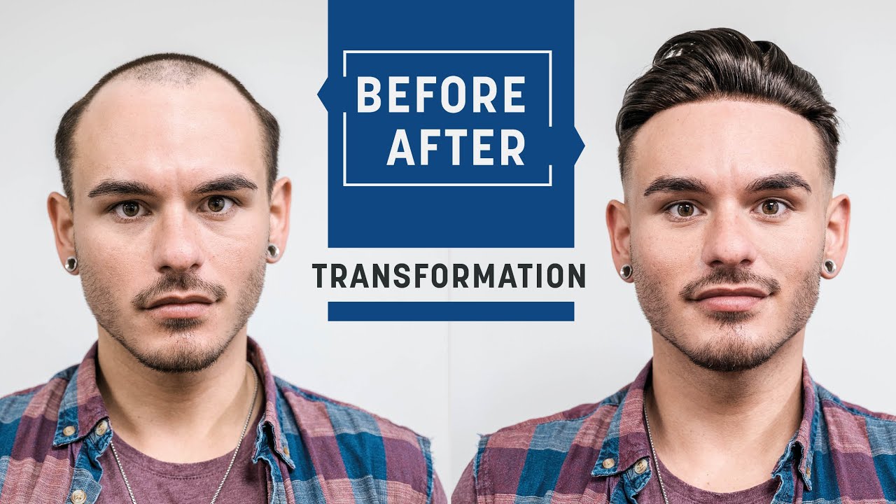 Perfect concealing of receding hairlines | Skin fade haircut with hairsystem | Hairsystems Heydecke