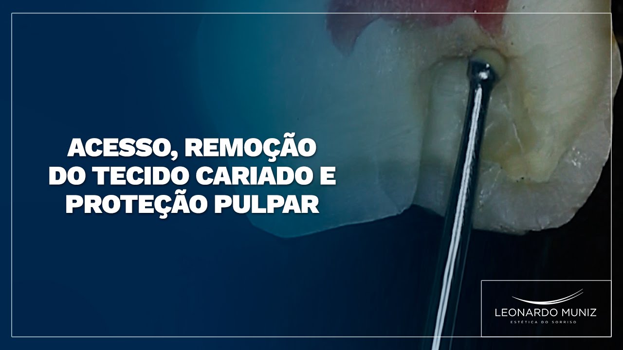 Acesso, Remoção do Tecido Cariado e Proteção Pulpar
