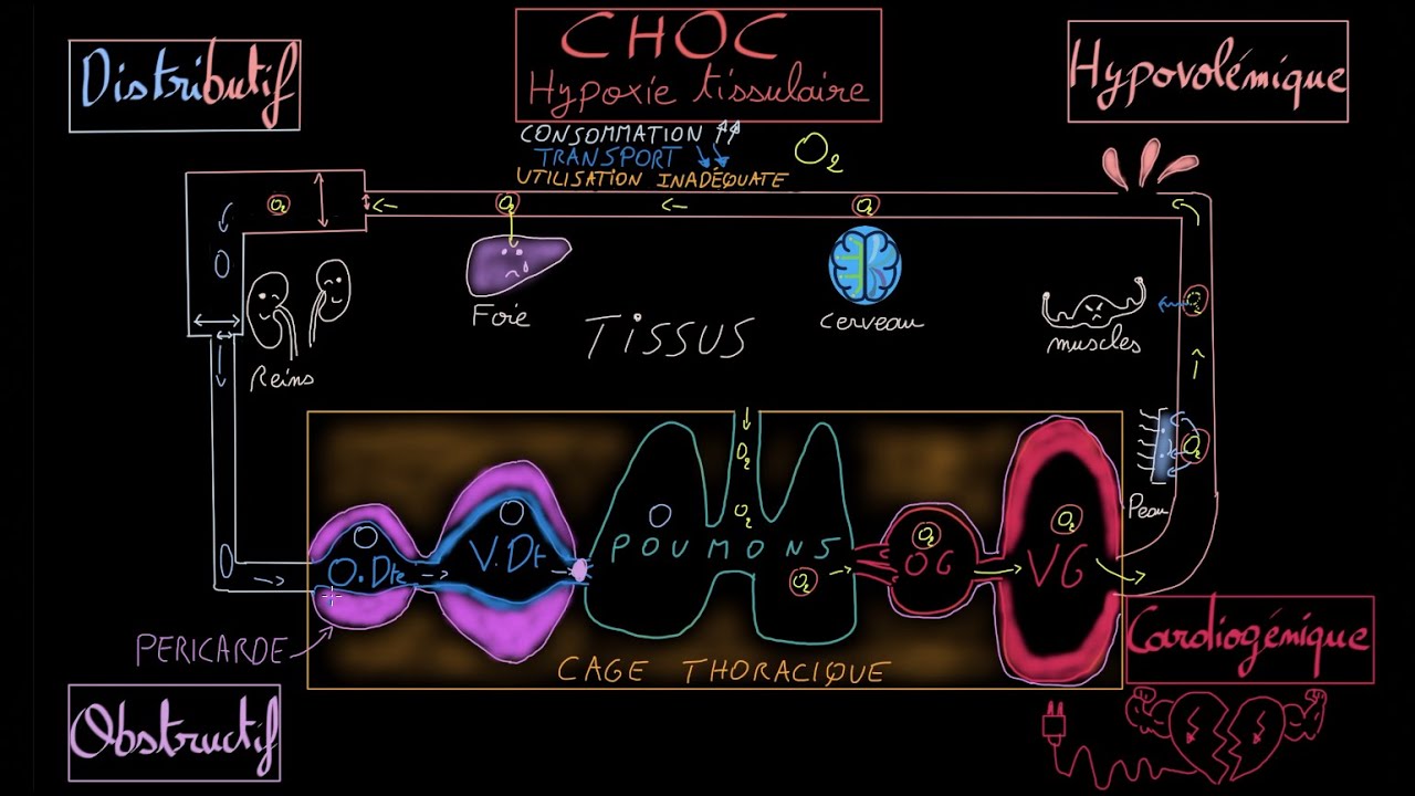 Choc - Cardiogénique - Hypovolémique - Distributif - Obstructif - Docteur Synapse