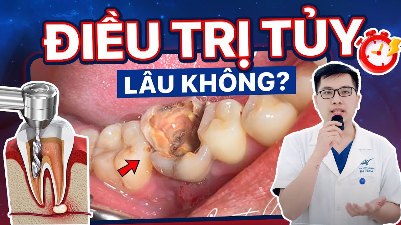 Điều Trị Tủy Răng Mất Bao Lâu? Cần Bao Nhiêu Lần Hẹn? Tại Sao Thời Gian Điều Trị Mỗi Người Khác Nhau