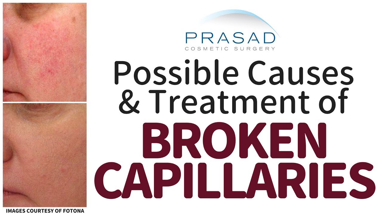 Potential Causes of Broken Capillaries on the Face, and How They can be Treated with Lasers