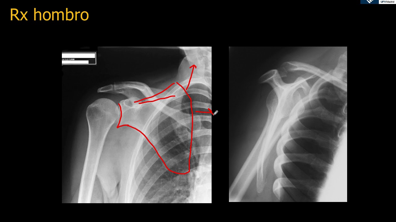 Anatomía Rx Hombro