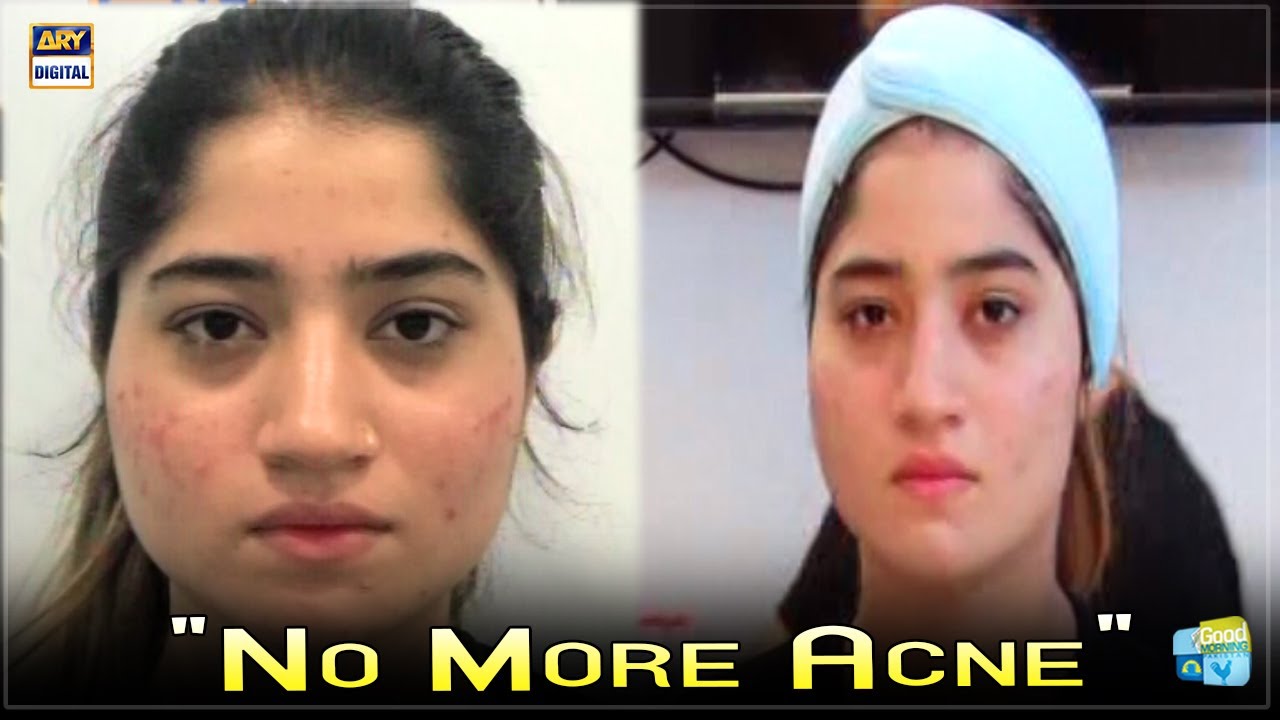 How To Get Rid Of Acne - Treatment By Shaista Lodhi