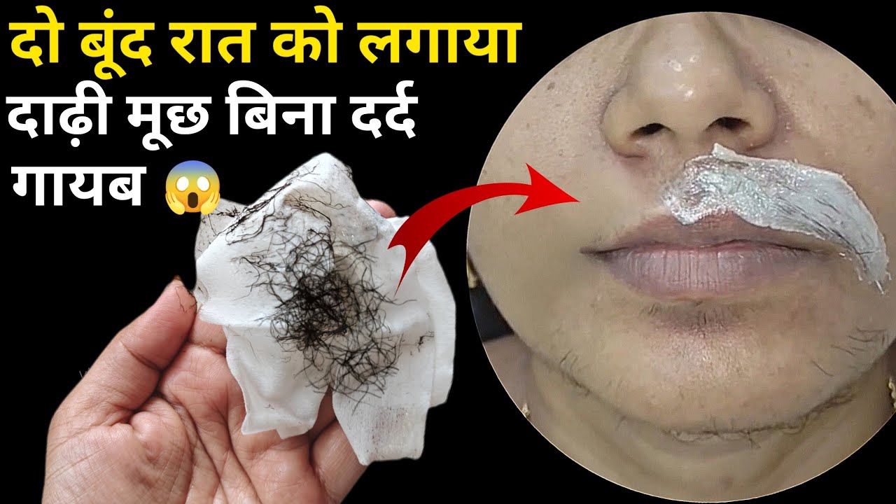 दाढ़ी मूछ से 4 साल से परेशान थी और इसे सिर्फ एक बार लगाया | anchahe Baal #skincare #wax #facialhair