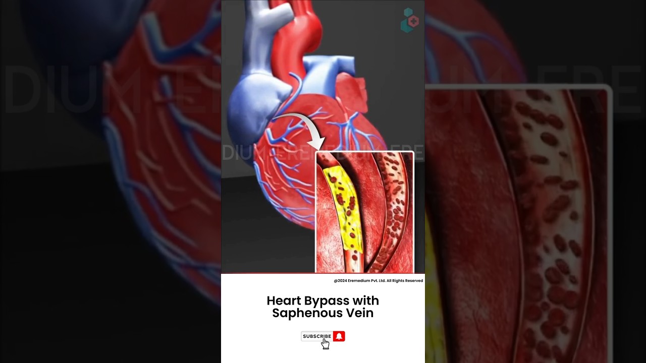 How Does Heart Bypass Surgery Work? ↪ 3D Medical Animation #Shorts #SaphenousVein