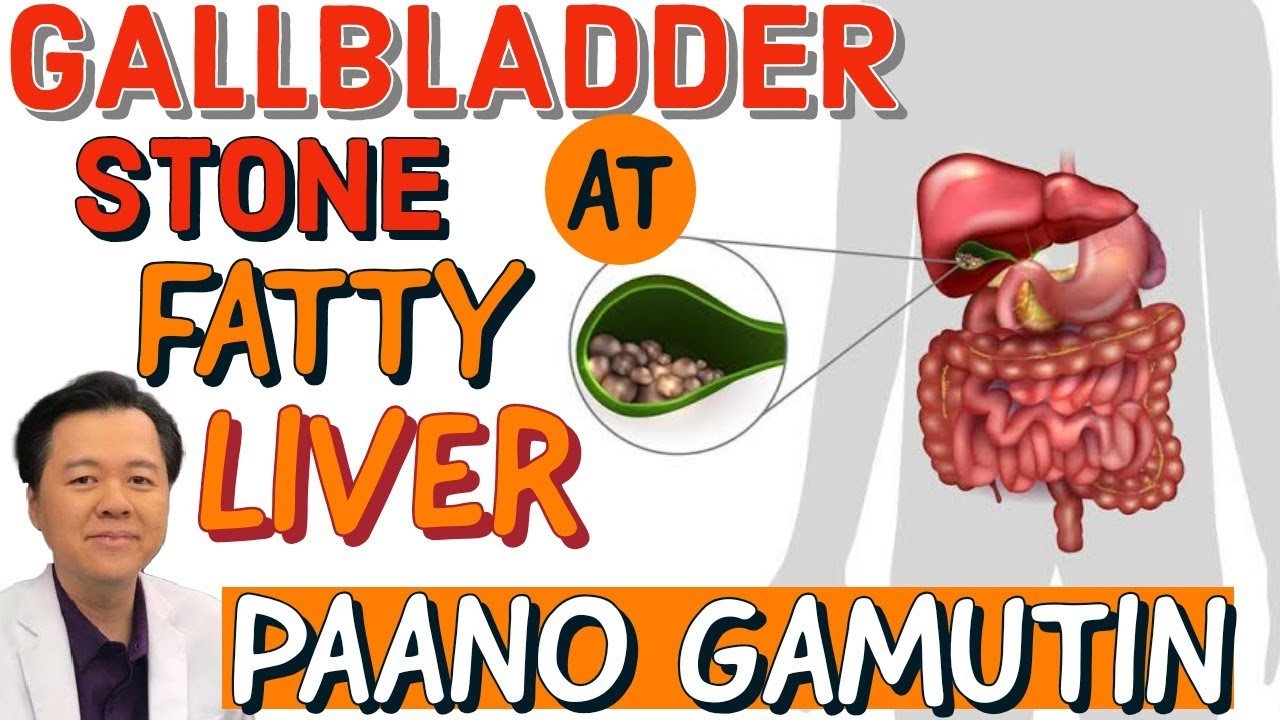 GallBladder Stone and Fatty Liver: Diyeta para Malunasan - Payo ni Doc Willie and Doc Liza Ong