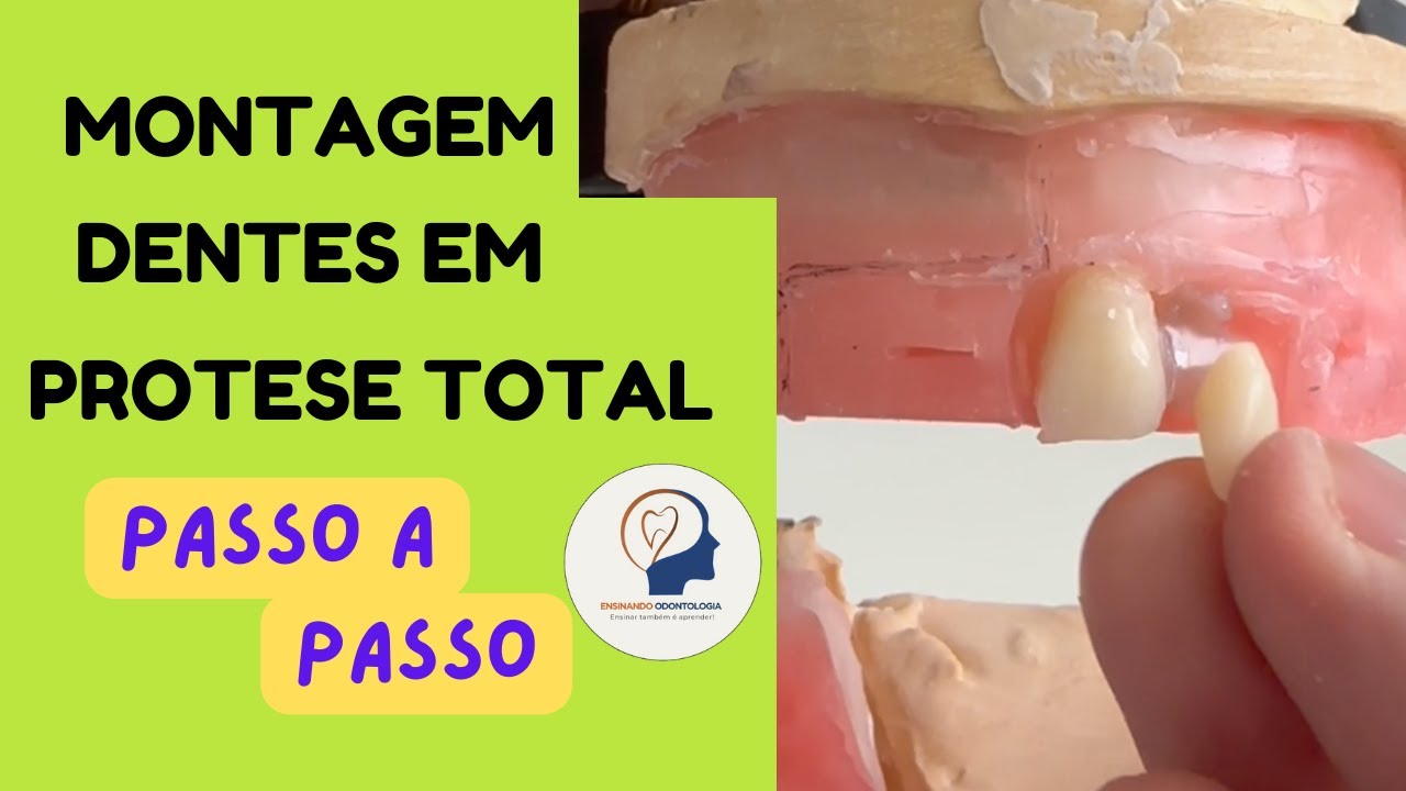 MONTAGEM DENTES EM PRÓTESE TOTAL