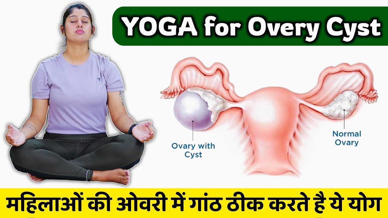 Ovary Cyst ke Liye Best Yoga | महिलाओं की ओवरी की गांठ मिटाएं बिना दवा