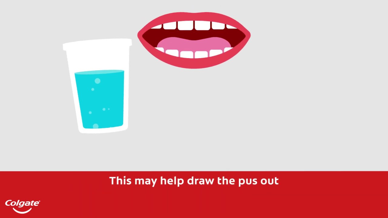 How To Treat a Gum or Tooth Abscess | Colgate&reg;