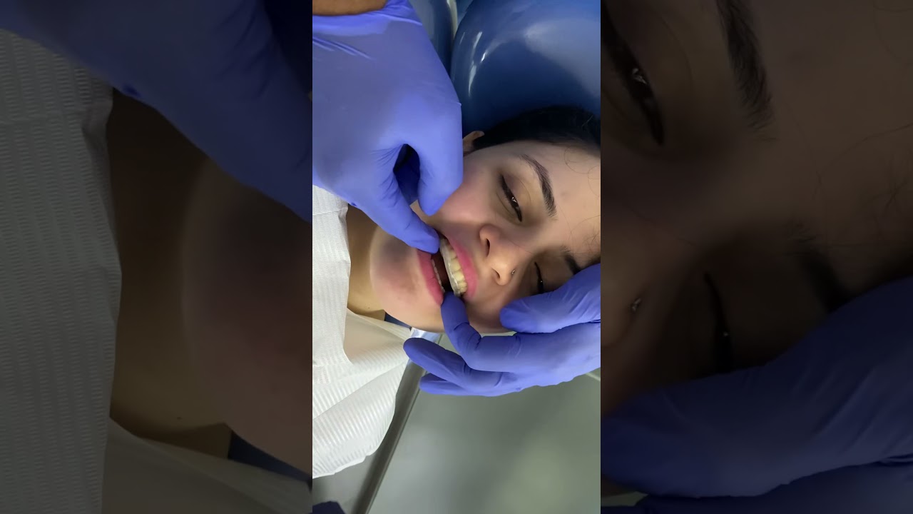#tmjpain #clenching #clicking TMJ pain - Jaw joint treatment with stabilising #splint