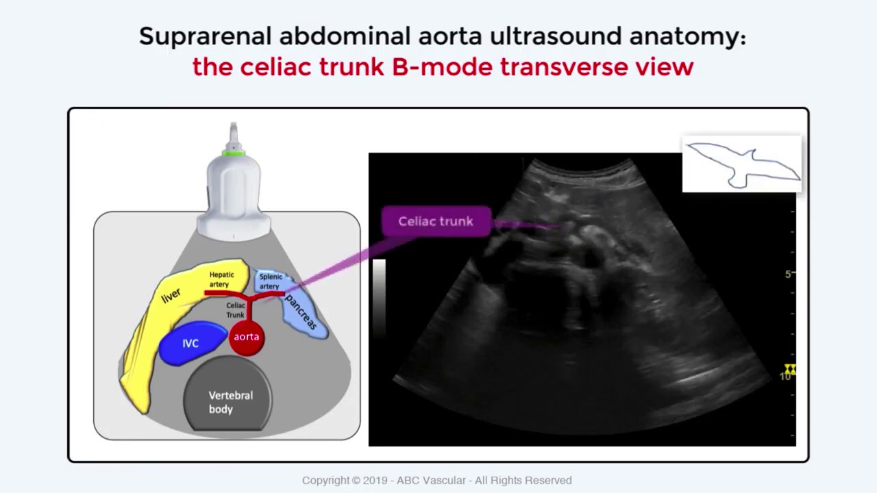 Celiac Trunk ultrasound appearance  vascular ultrasound learning