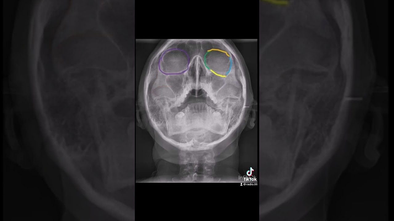 Anatomía Radiológica de Cráneo en imágenes de radiografía - Proyección de Waters.