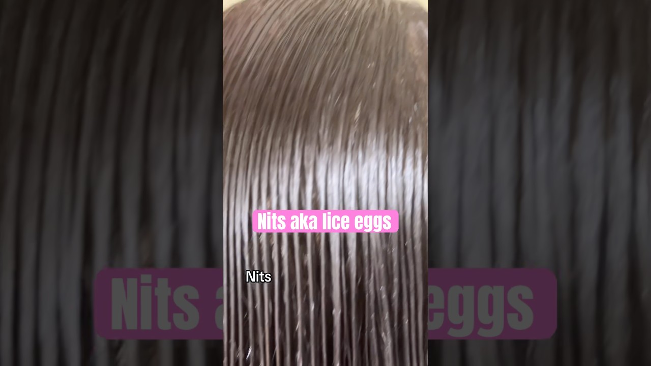 Nits on hair l lice eggs