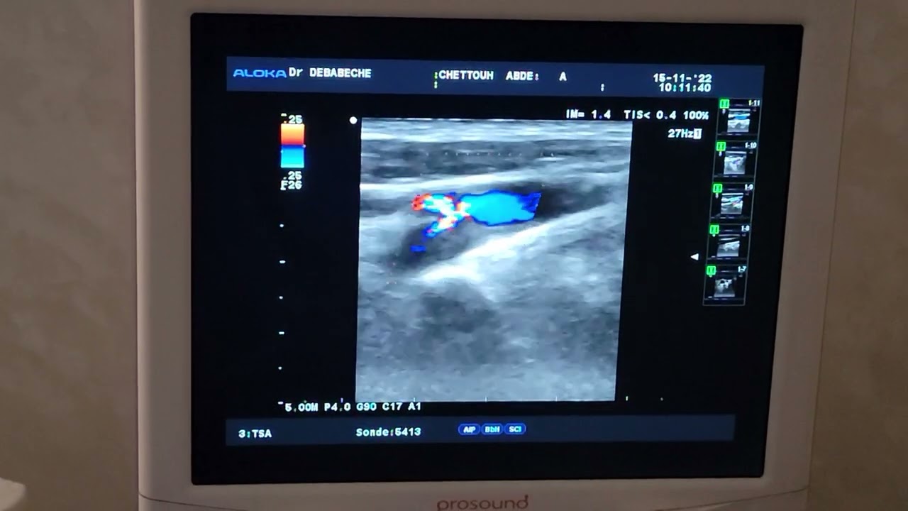 sténose  serrée de la  carotide interne proximale ..indication d'une endarteriectomie.