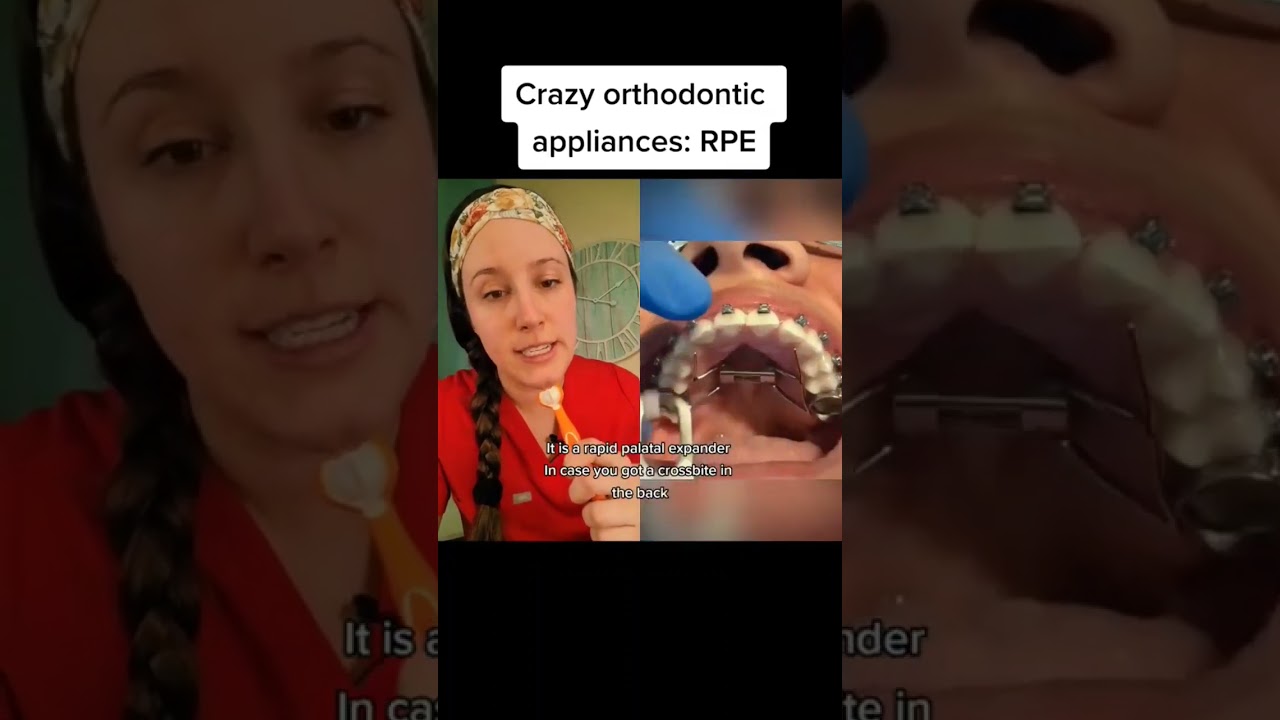 Palatal expander removal 🧐