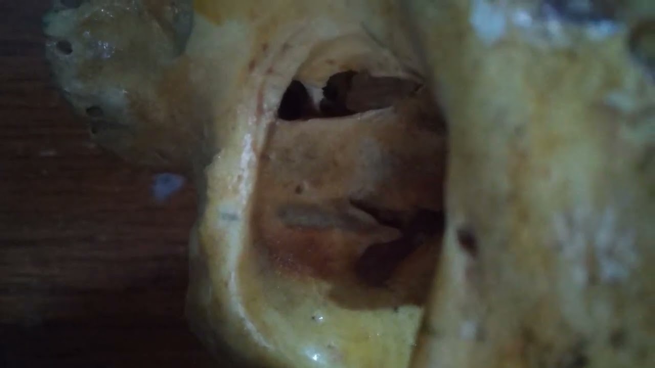 Supraorbital foramen