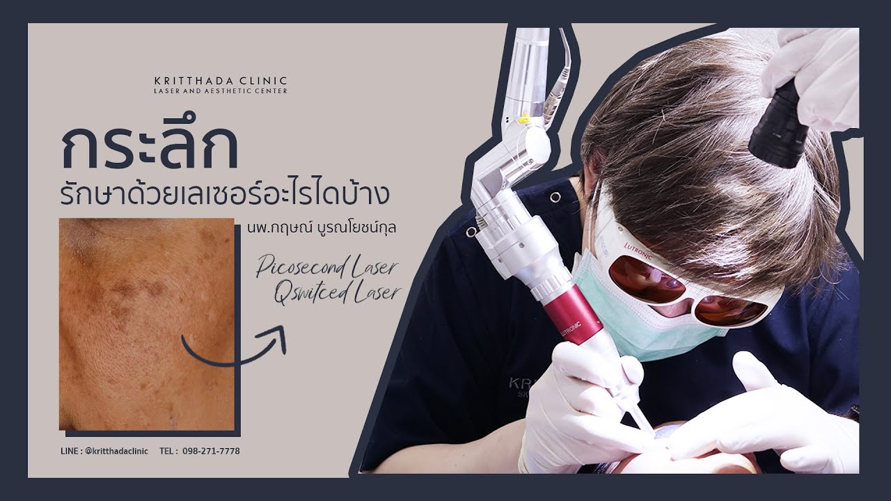 กระลึก รักษาได้ด้วยเลเซอร์ อะไรบ้าง I Kritthada Clinic I Pico Laser