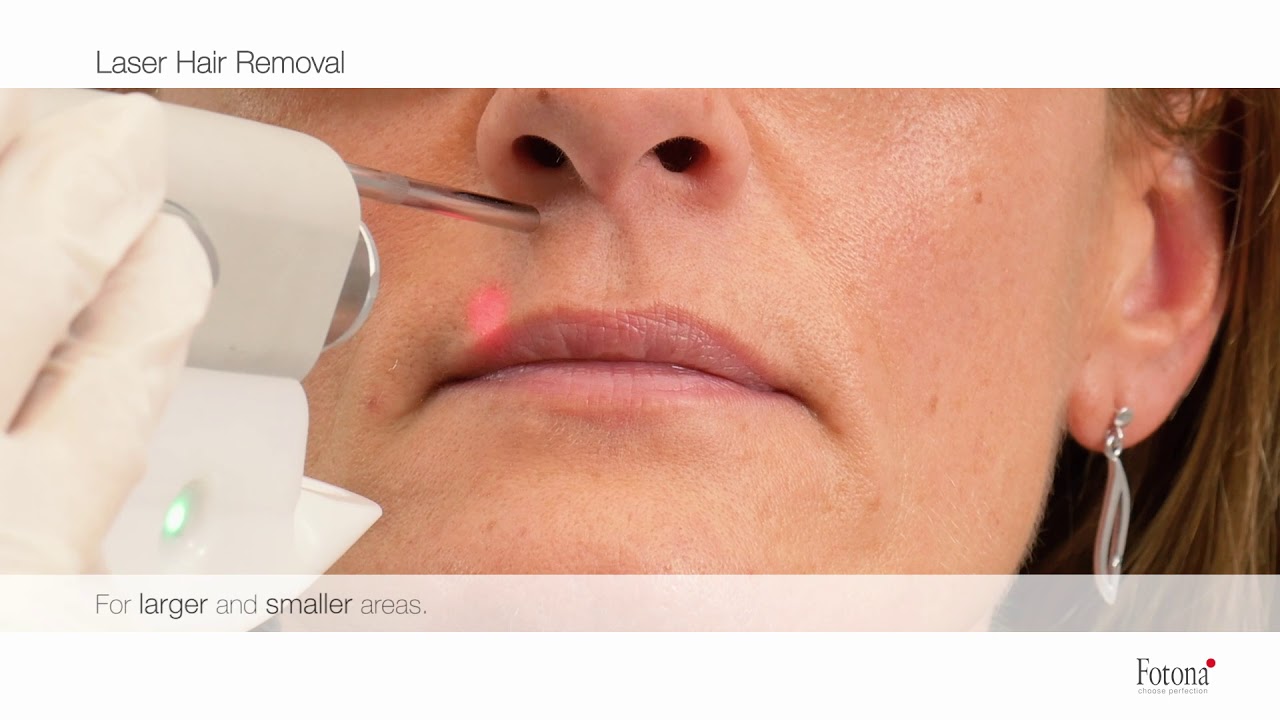 Fotona Laser Hair Removal