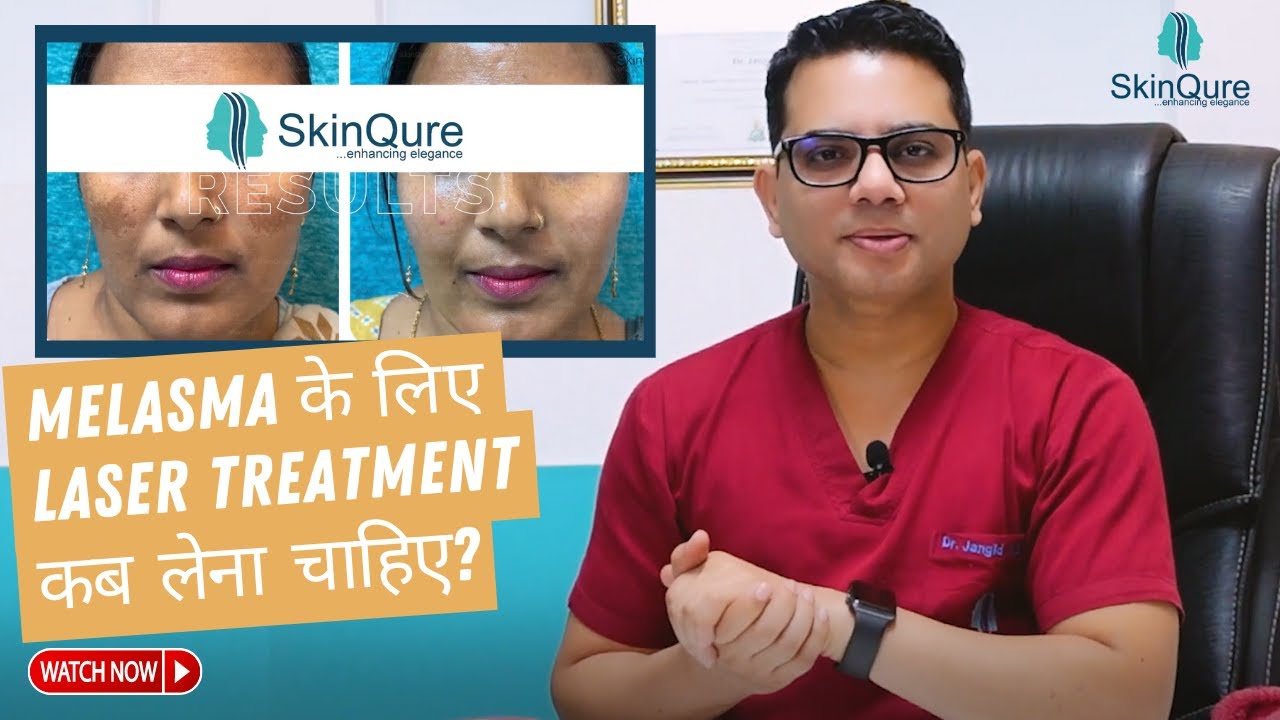 Best Treatment for Melasma | Laser Treatment for Melasma in Delhi | SkinQure | Dr. Jangid