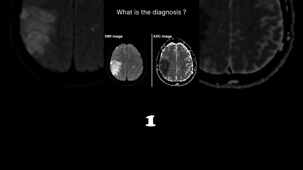 Diffusion weighted imaging – Infarct (brain) Quiz 19 #