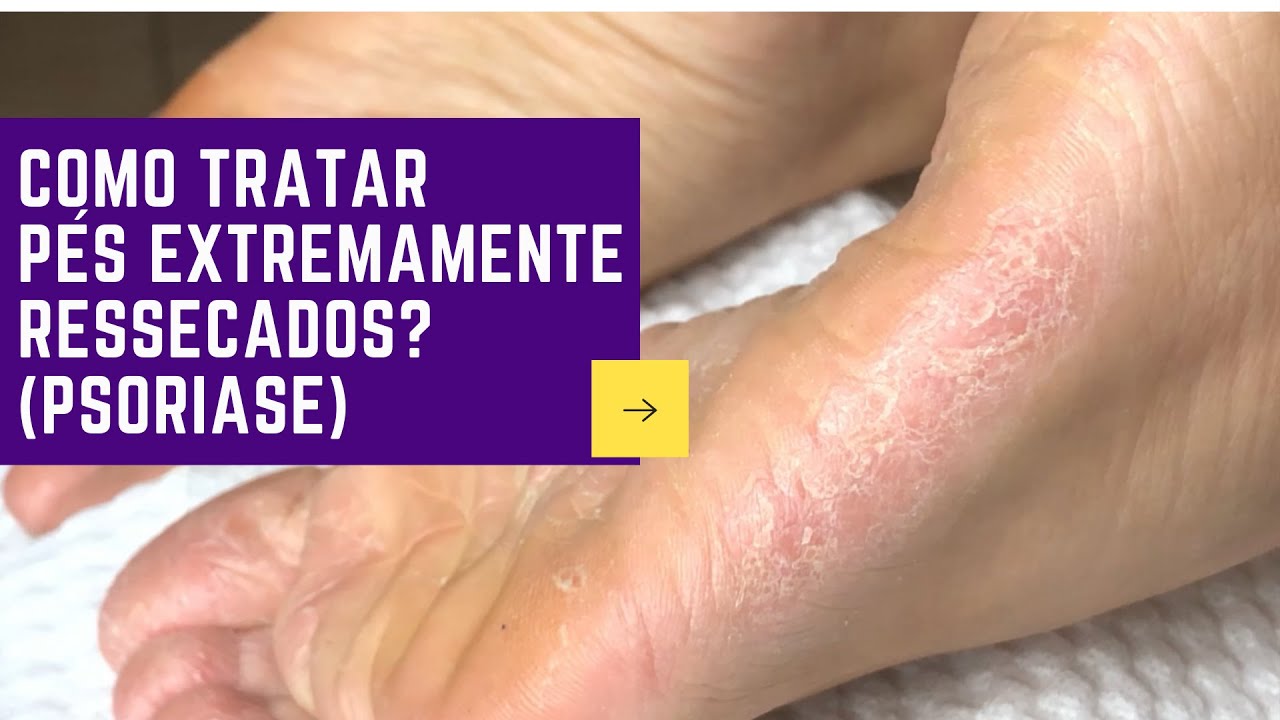 COMO TRATAR PÉS EXTREMAMENTE RESSECADOS | PSORIASE | Podóloga Paola Brígido
