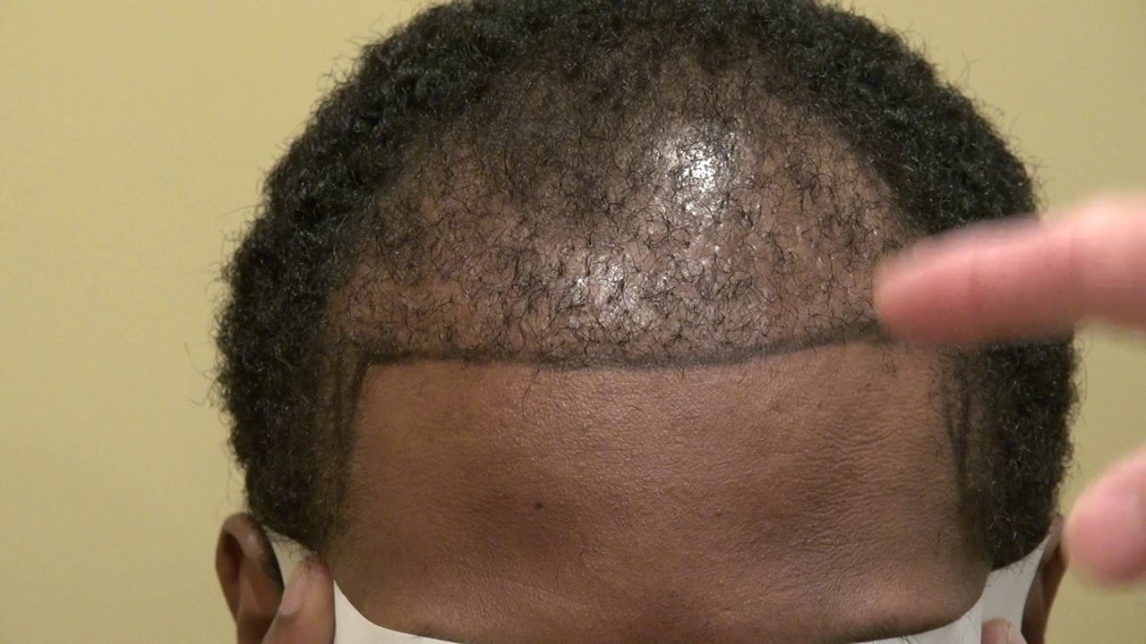 Black African Hair Plugs & Poor Hair Transplant Surgery Result To Be Repaired by Dr. Diep