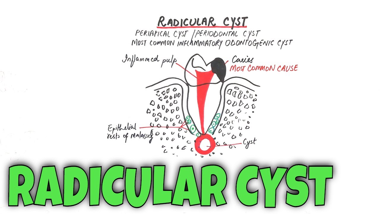 Radicular cyst / Periapical Cyst - Pathogenesis, Clinical, RF, HF & Treatment