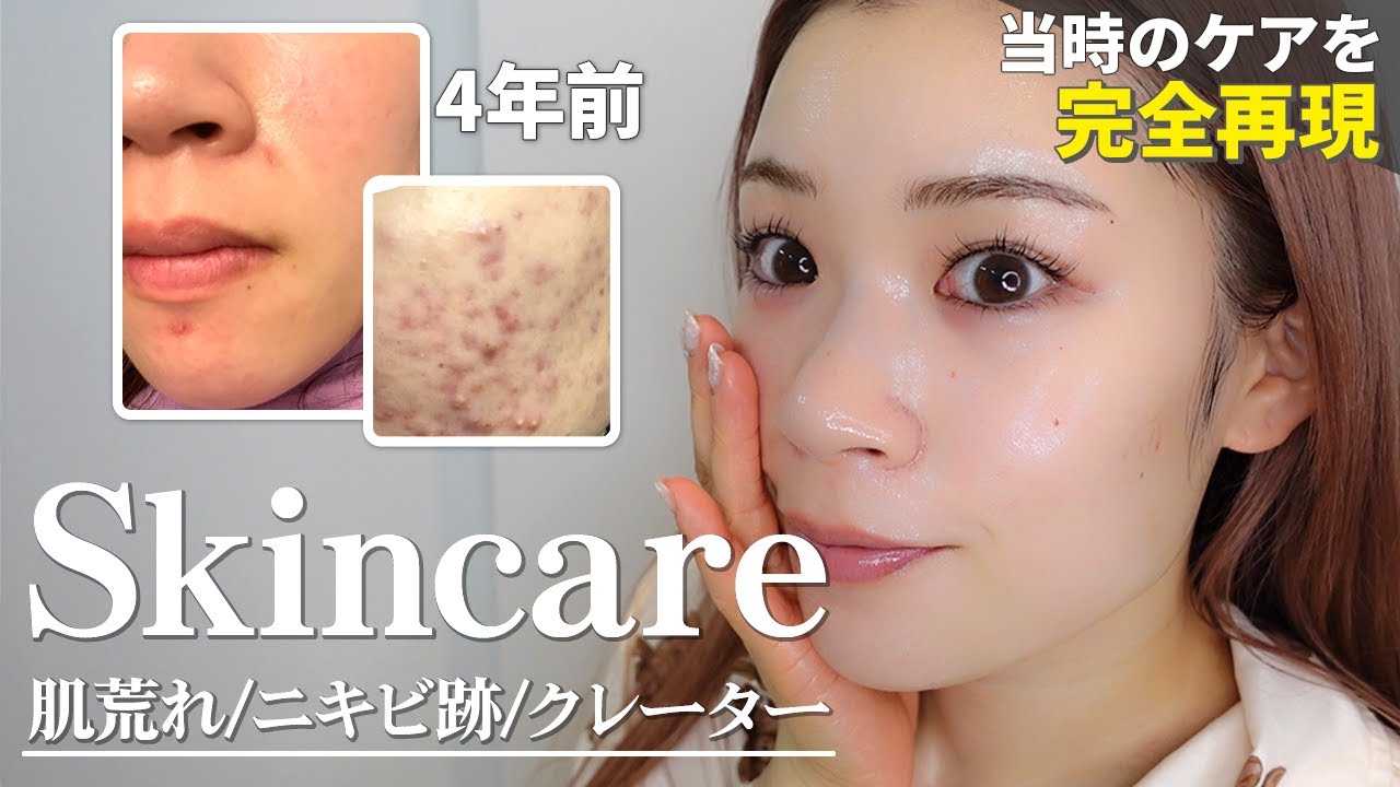 【本気で治す】皮膚科なし！ニキビ跡を残さず消したスキンケア完全再現🔥💯