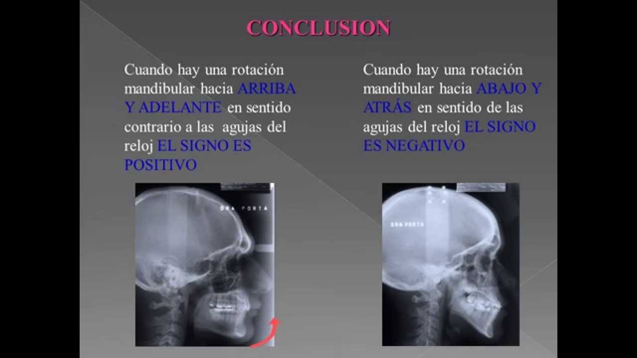 Cefalometria de Ricketts: La Mejor Explicación!!