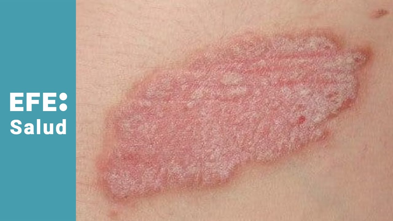 Frente a la psoriasis, más y mejores medicamentos