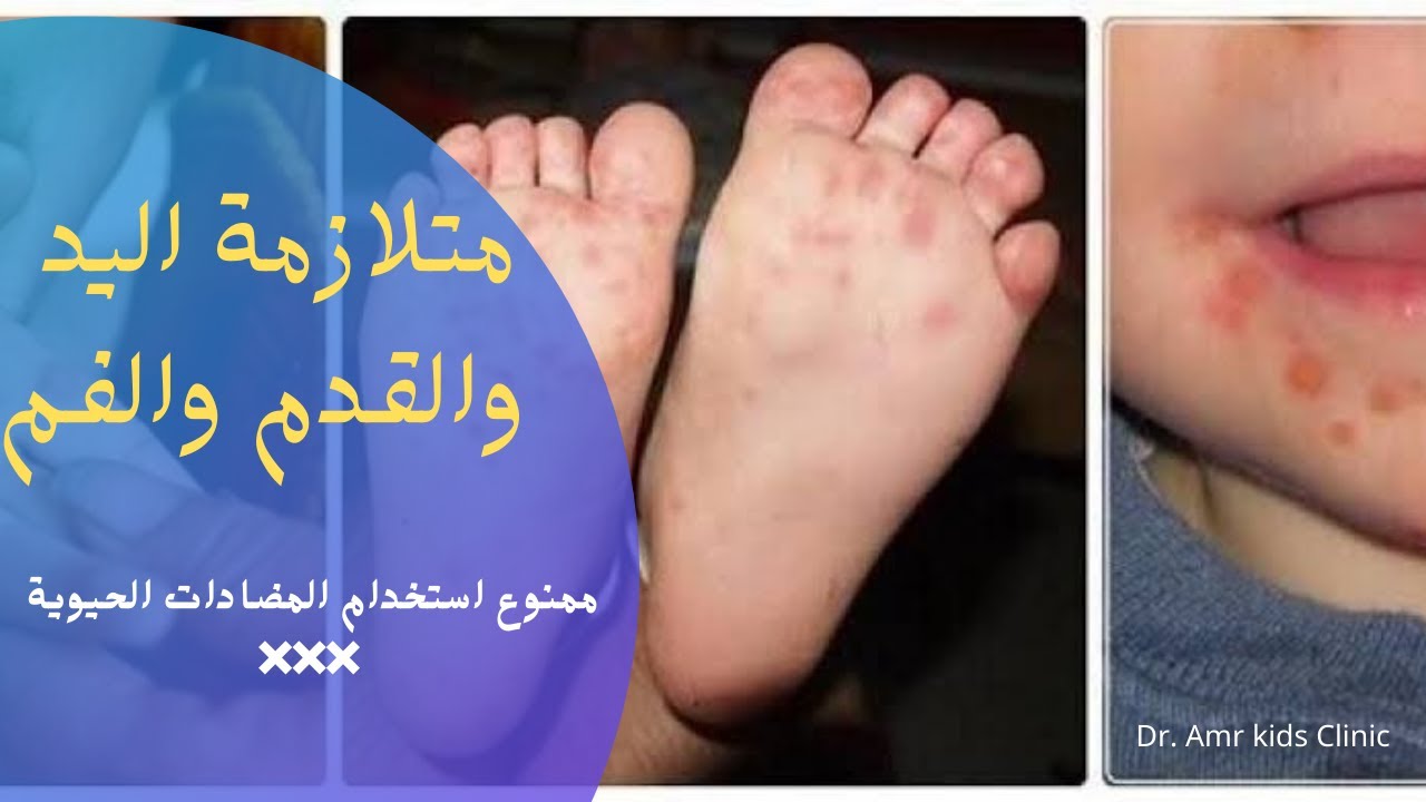 متلازمة اليد والقدم والفم / ممنوع استخدام المضاد الحيوي/ أحد أشد الأمراض عدوى
