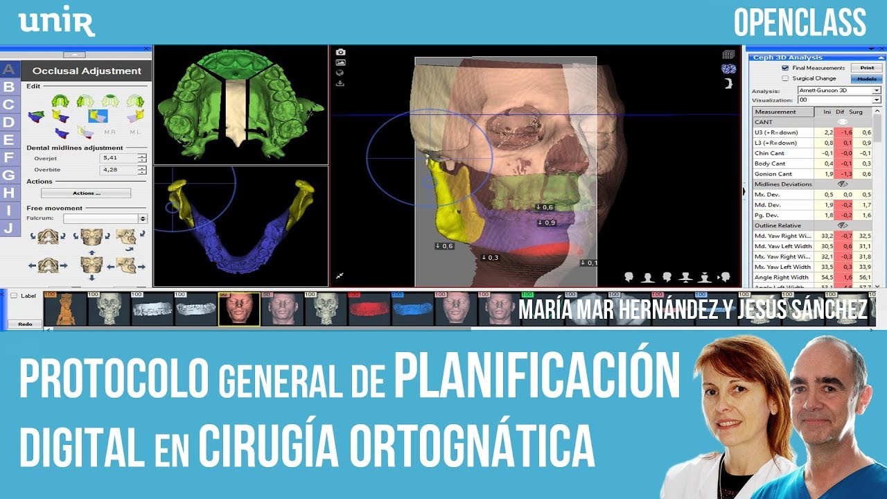 Protocolo general de Planificación Digital en Cirugía Ortognática