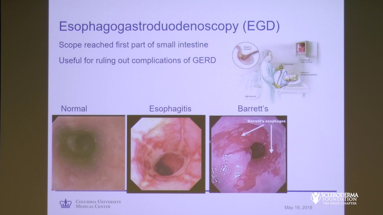GI Dysmotility in Scleroderma: Not Just the Esophagus! - Daniela Jodorkovsky, MD