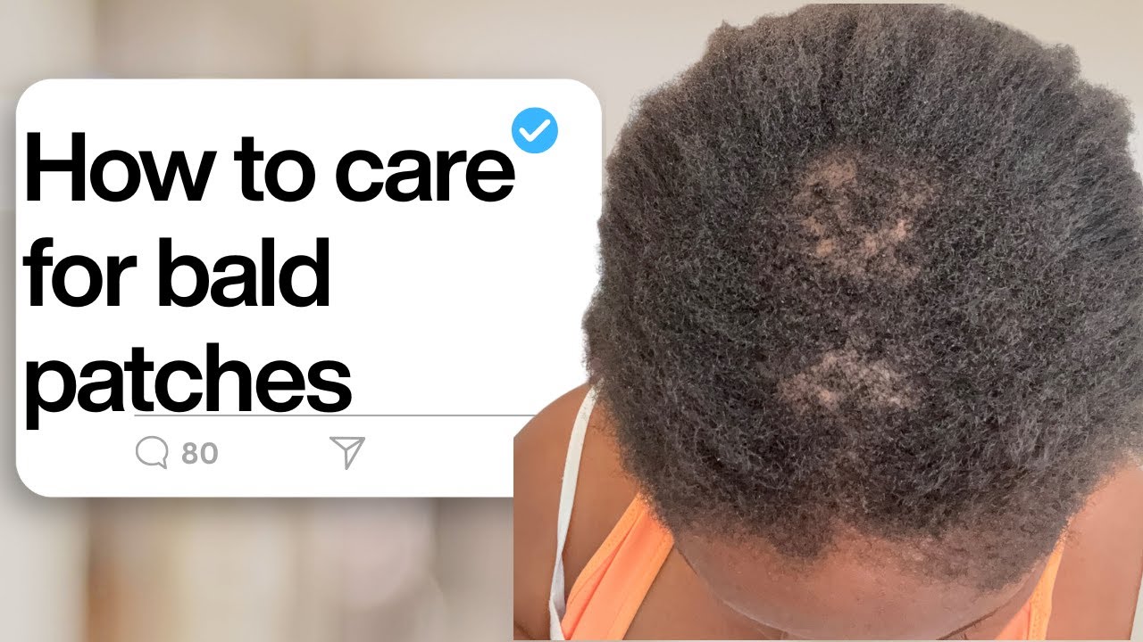 How to Treat Bald patches from relaxers
