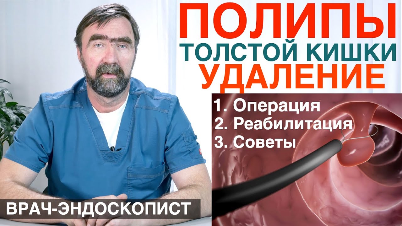 ПОЛИПЫ ТОЛСТОЙ КИШКИ - удаление полипов кишечника, ОПЕРАЦИЯ, осложнения,рекомендации после удаления