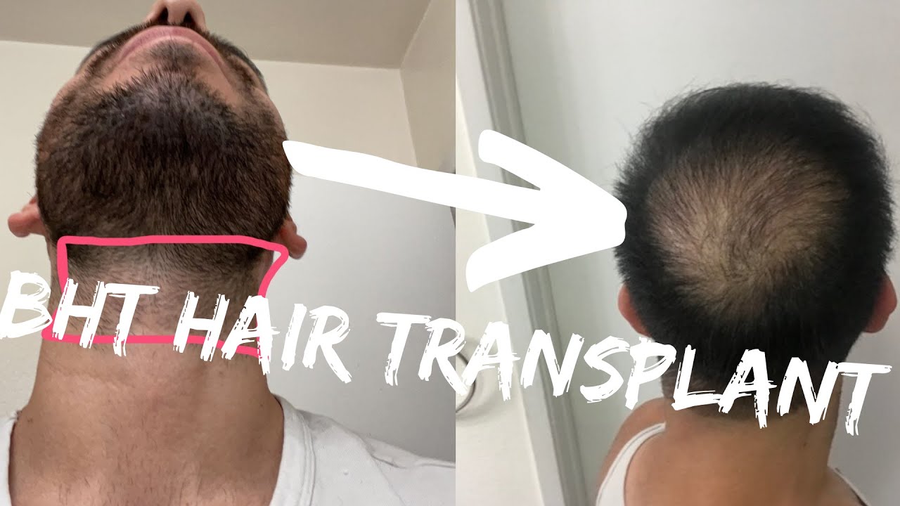 How Many Grafts Can You Get From The Beard?