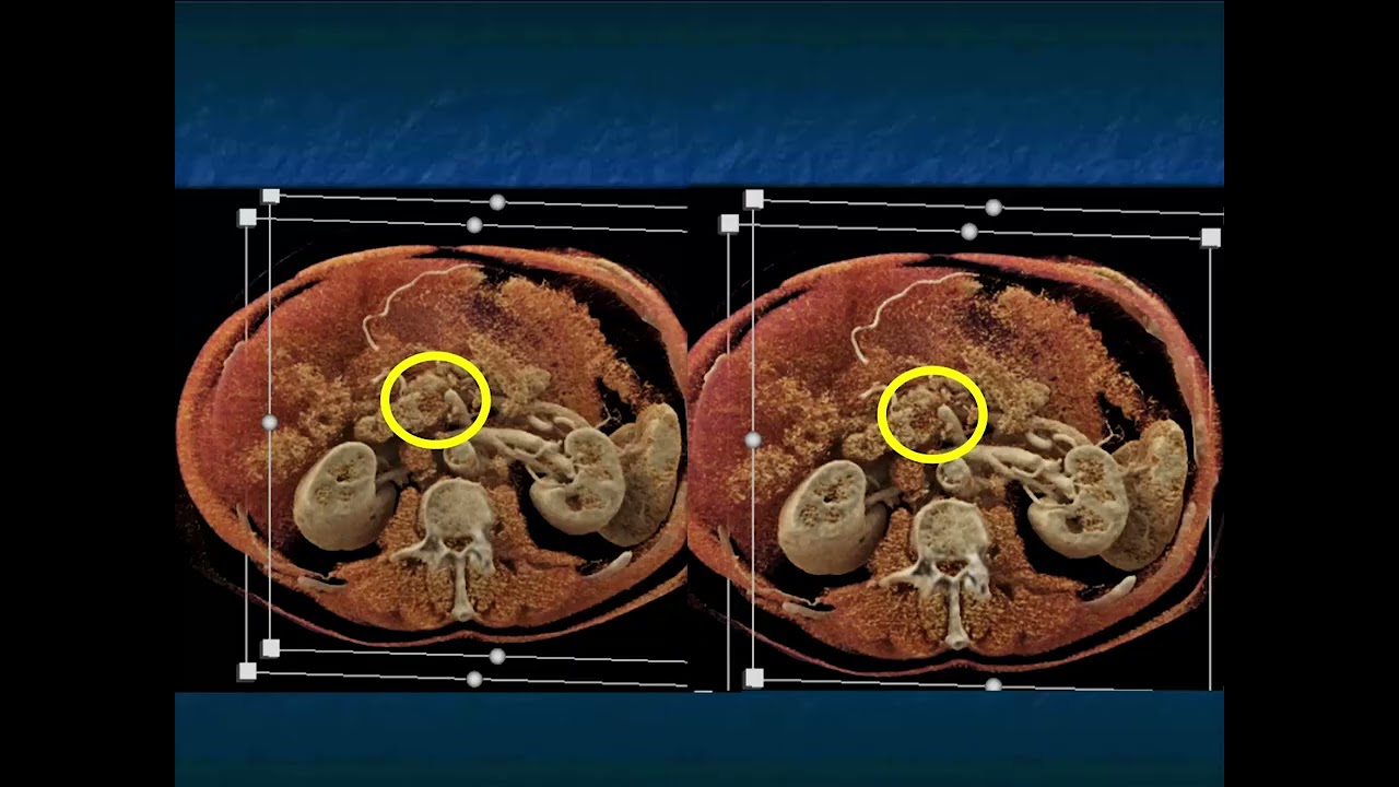 The Earlier Detection of Pancreatic Cancer and the Role of AI and Radiomics - Part 1
