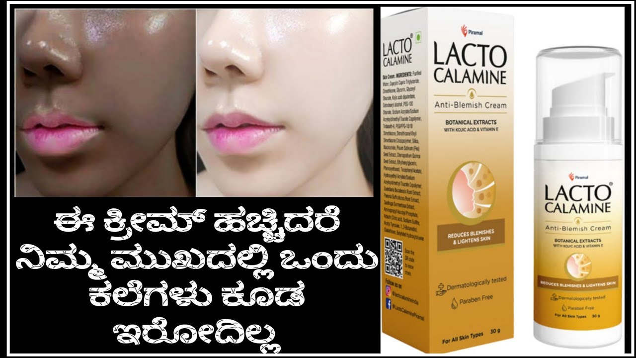 Lacto calamine Anti-Blemish Cream Review In Kannada||Remove Pigmentation||Dark spots||100% Result||