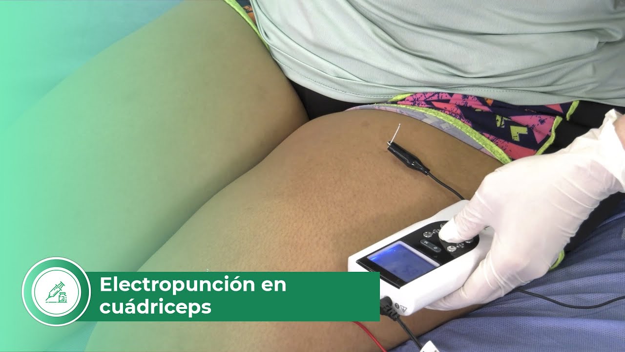 Electropunción en Cuádriceps