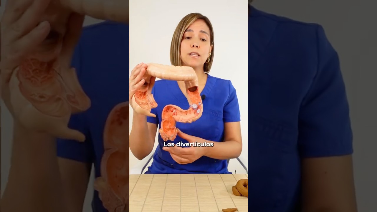 Tienes diverticulos? O diverticulosis? O tuviste diverticulitis?
