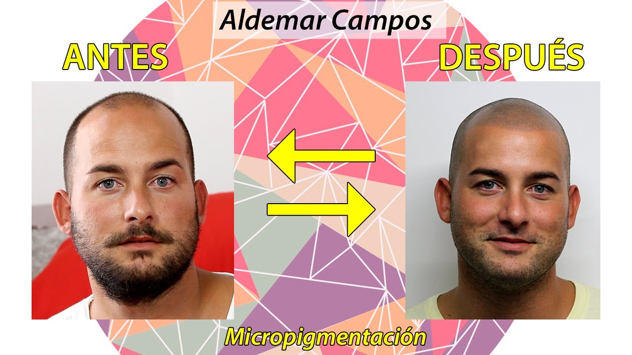 [ENGLISH SUB] Un cambio positivo gracias a la Micropigmentación Capilar