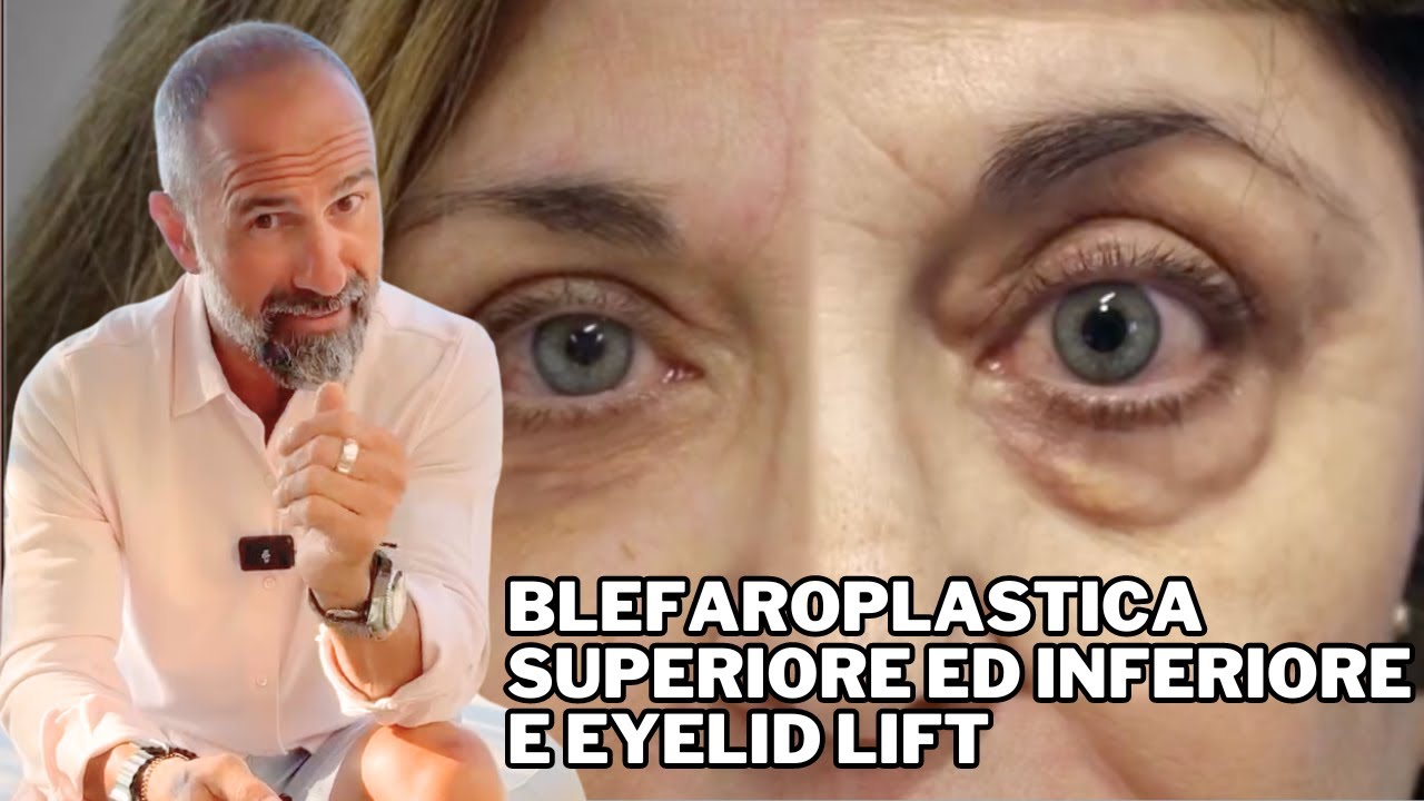 Blefaroplastica superiore ed inferiore e  eyelid lift
