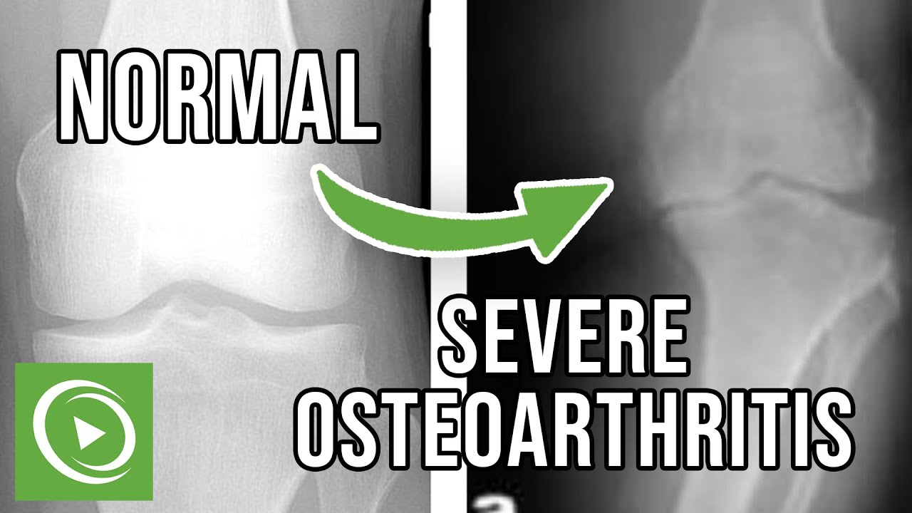 Osteoarthritis: Case Review and Radiography | Lecturio