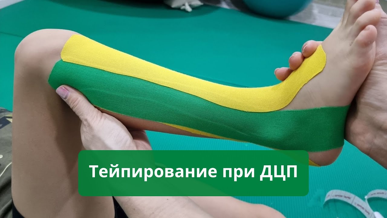 Тейпирование при ДЦП / Тейпування дітей при ДЦП - Наш Всесвіт Харьков