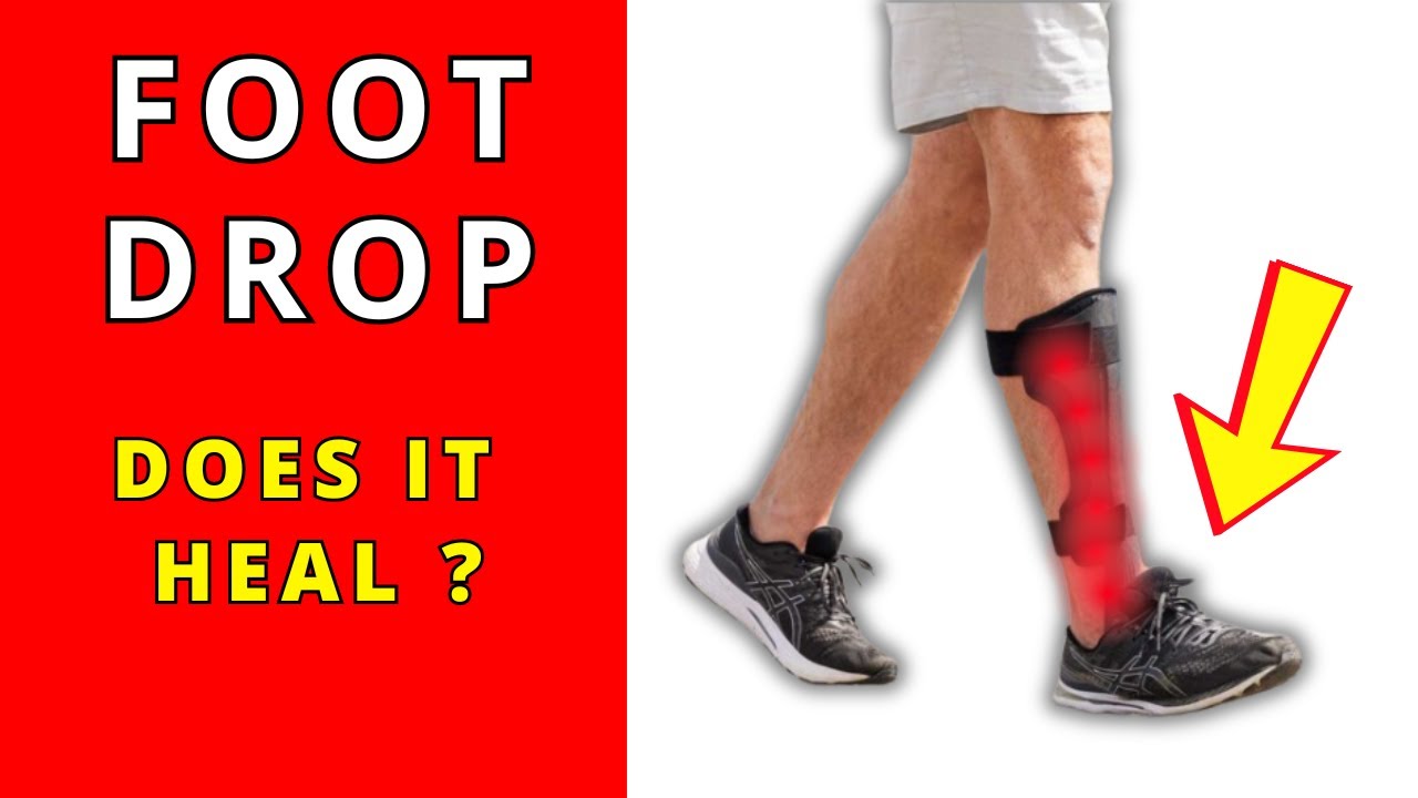 How long it takes to heal the Foot Drop?
