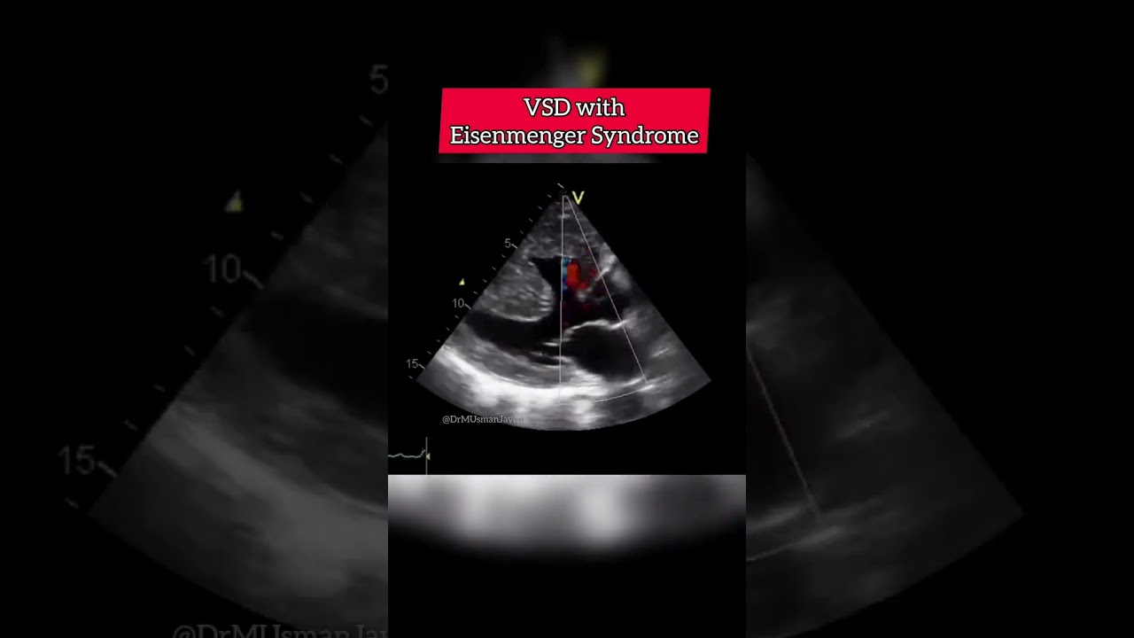VSD with Eisenmenger Syndrome #echocardiography #echocardiogram #echo #shorts