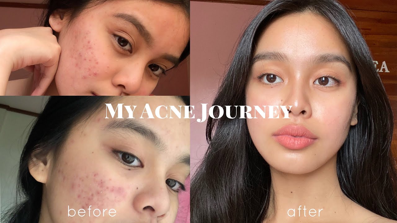How I Cleared my Acne (somehow) PHILIPPINES | Lj Torres